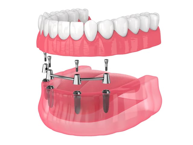 All-on-4 Implants