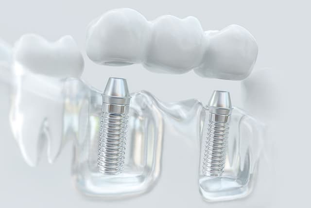 Multiple Teeth Implants