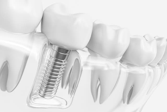 Single Tooth Implant