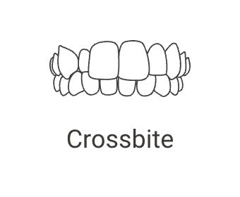 Crossbite