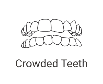 Crowded Teeth