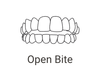 Open Bite