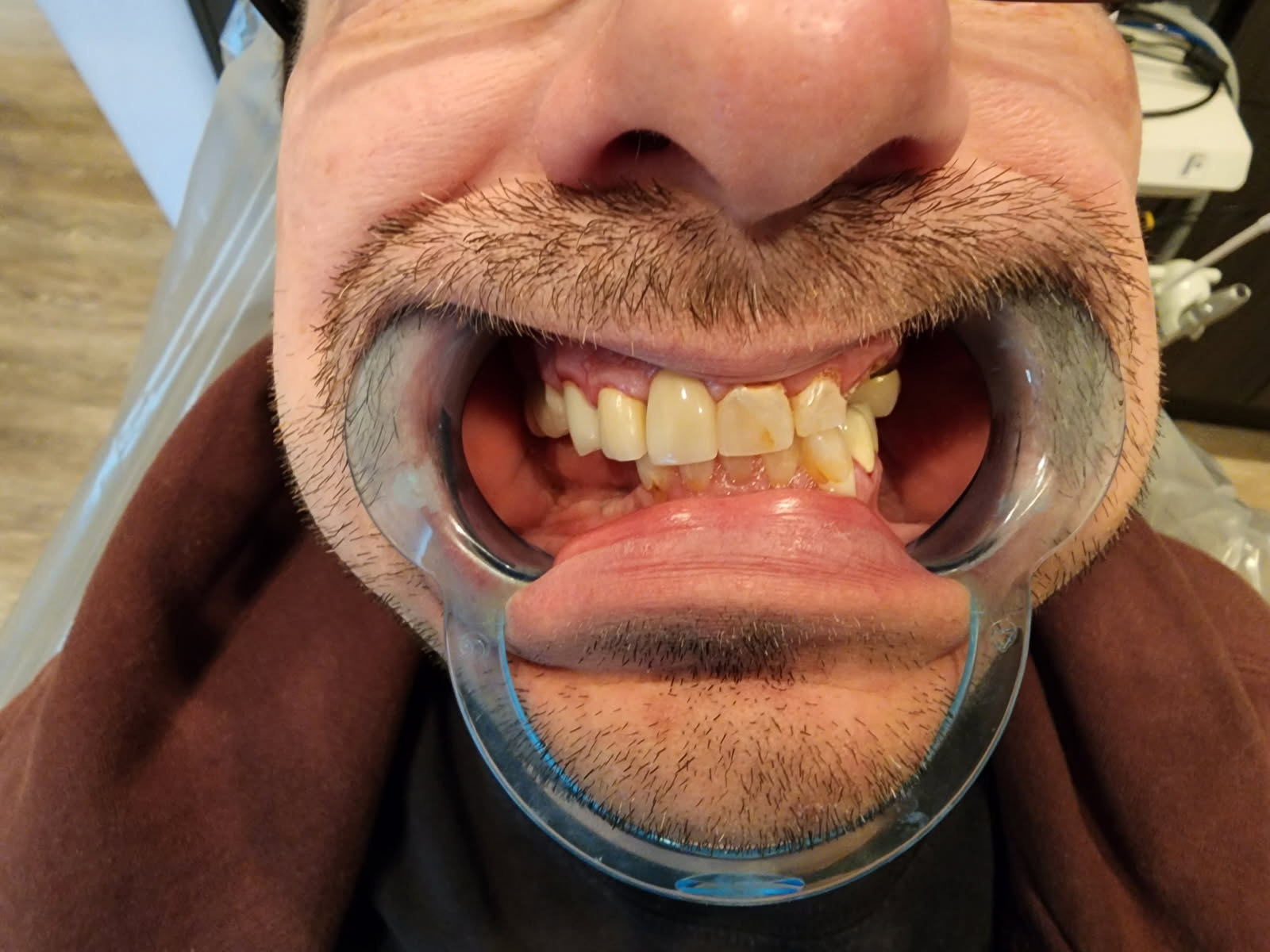 After - Tooth stain removal