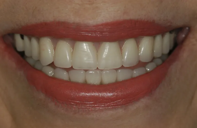 Before - Single tooth implant replacement