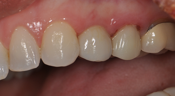 Before - Multiple tooth implant restoration