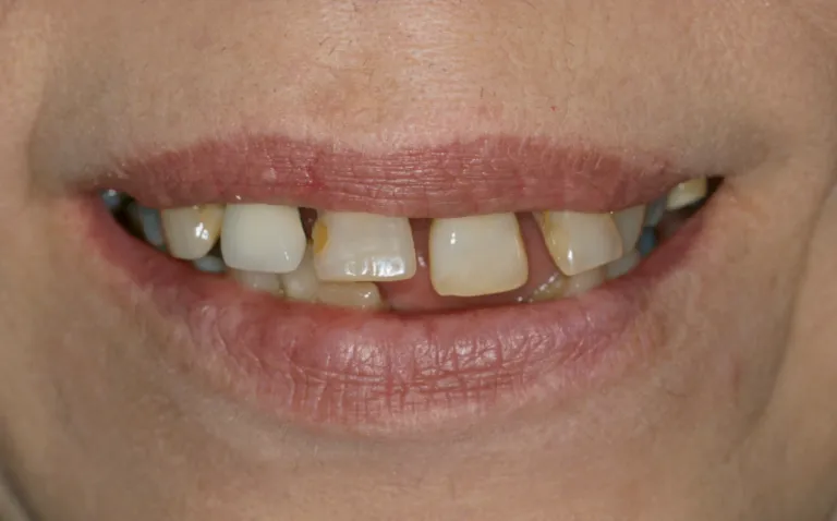 After - Single tooth implant replacement