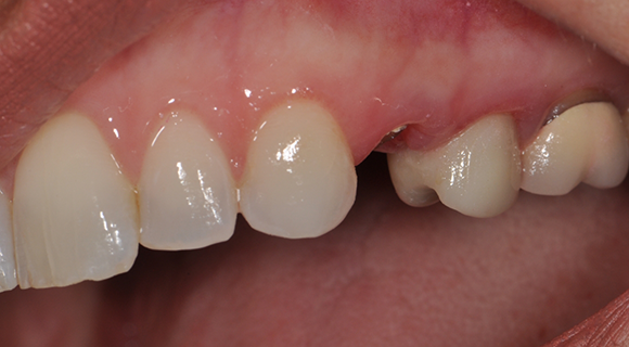 After - Multiple tooth implant restoration