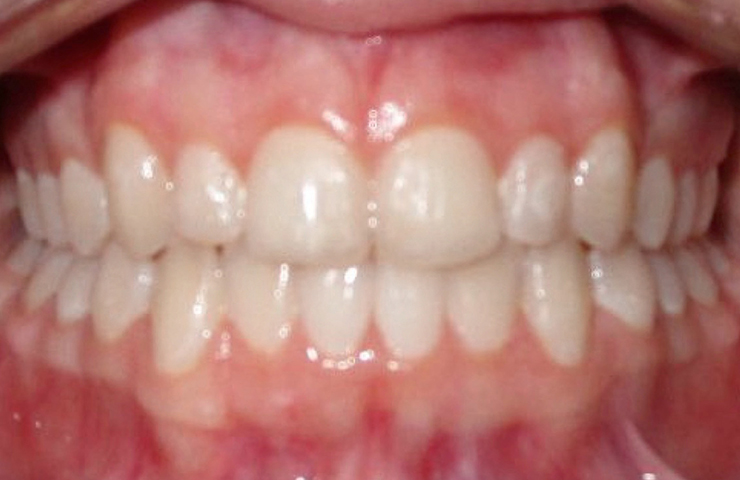 Before - Cosmetic dental restoration