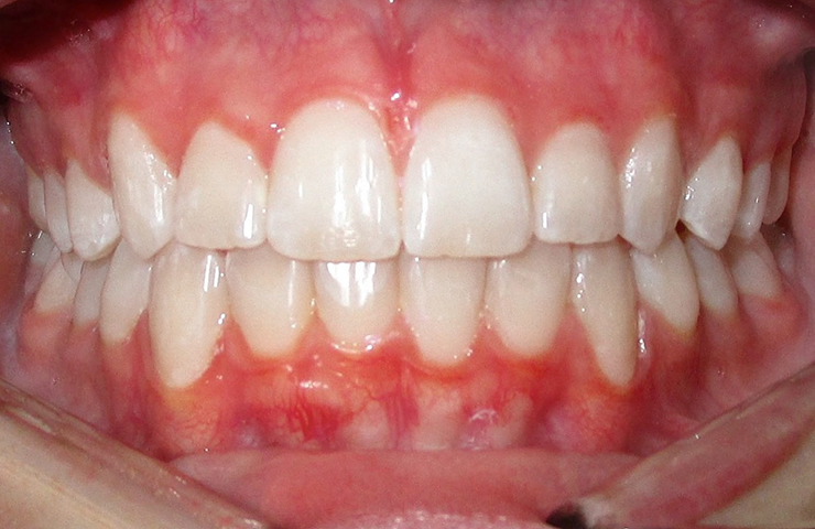 Before - Chipped tooth replacement