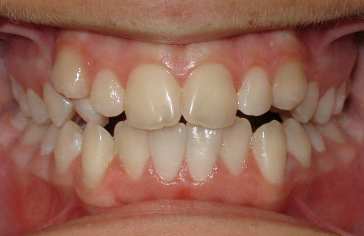 After - Cosmetic dental restoration