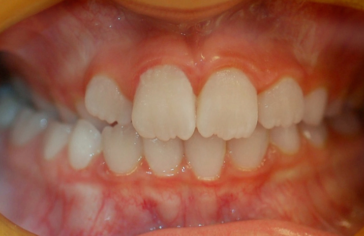 After - Chipped tooth replacement